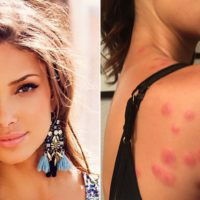 famous model gets bitten by bed bugs in hotel room